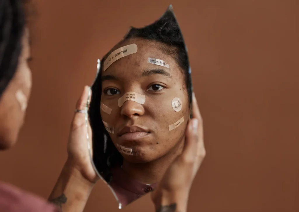 femme métisse avec des boutons et des taches sur le visage